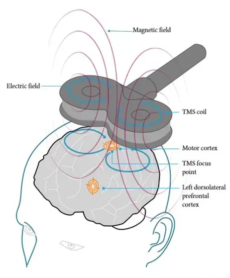 rTMSとは？うつ病に対する新療法